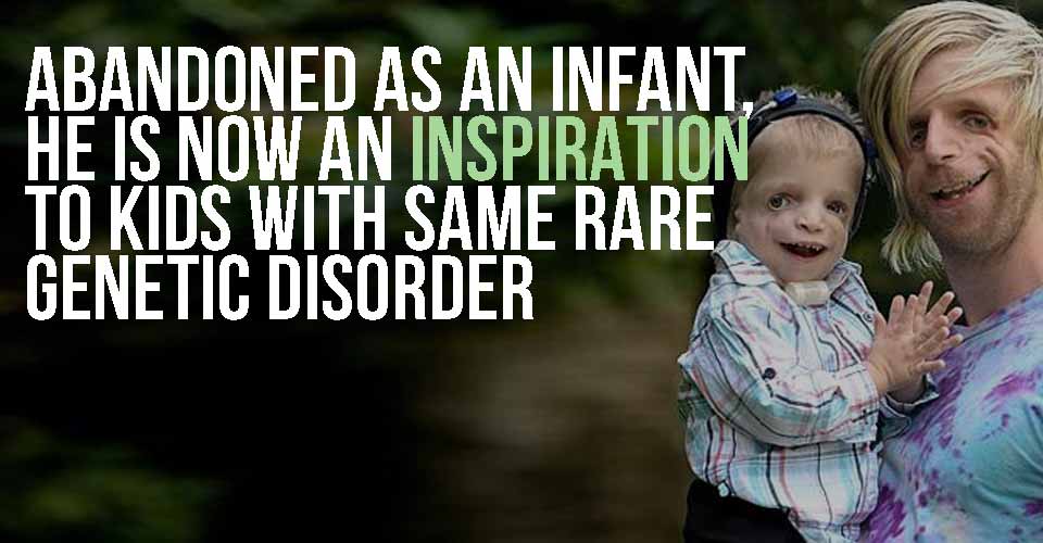 Abandoned As An Infant, He Is Now An Inspiration To Kids With Same Rare Genetic Disorder