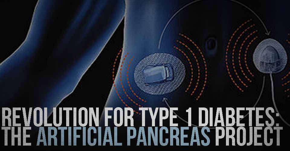 Revolution for Type 1 Diabetes: The Artificial Pancreas Project