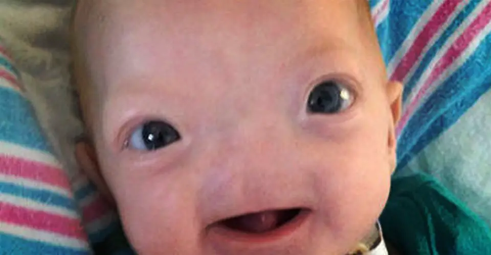 Baby Eli Was Born Without A Nose And He's Adorable!