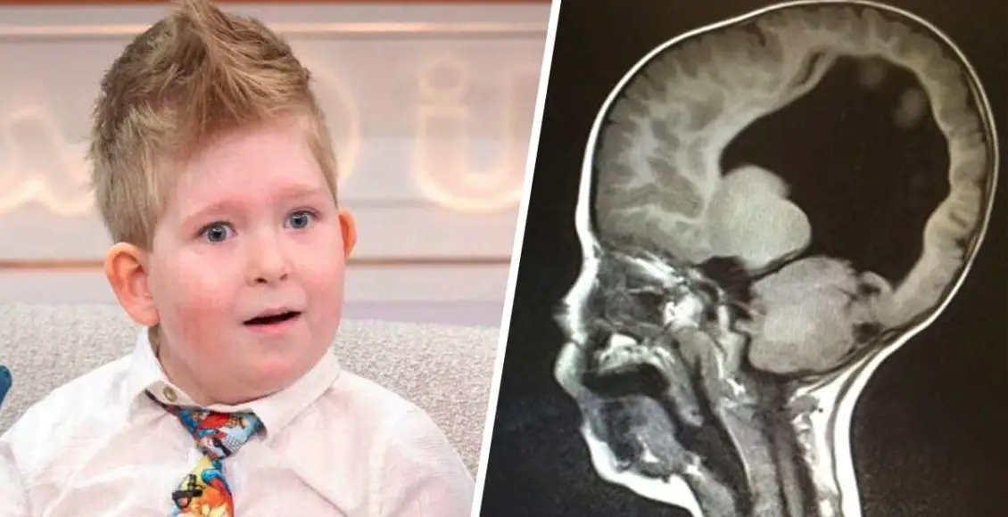 An "Extraordinary" Boy Born With 2% of Brain, Recovered The Bigger Part Of It By The Age Of Three