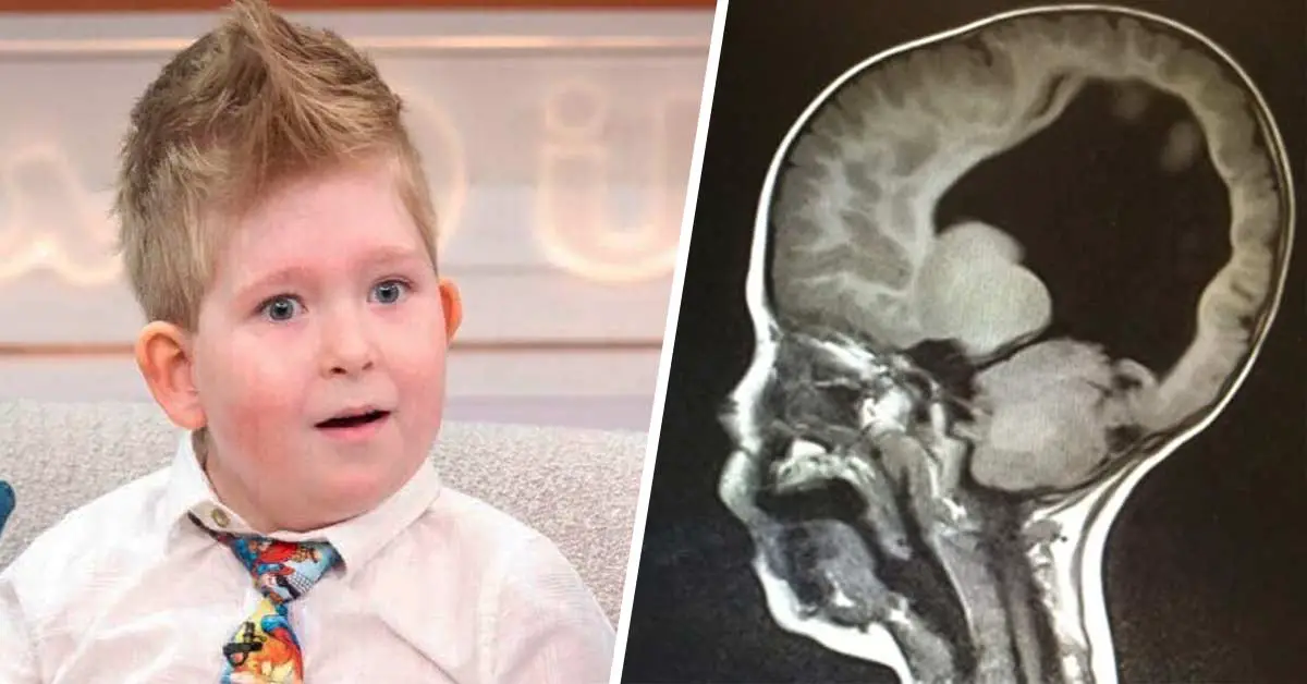 An "Extraordinary" Boy Born With 2% of Brain, Recovered The Bigger Part Of It By The Age Of Three