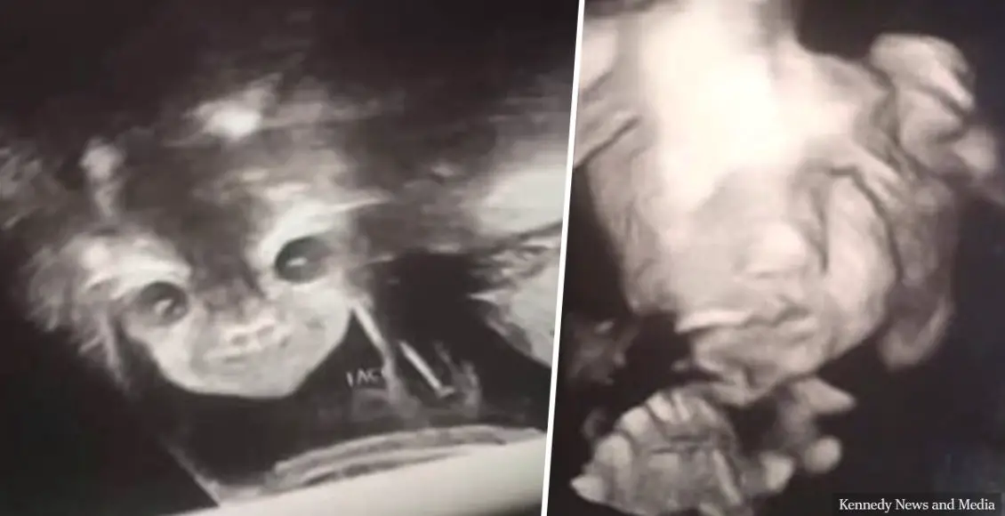 Shocking pregnancy scan of staring 'devil baby' scares a young mom to be