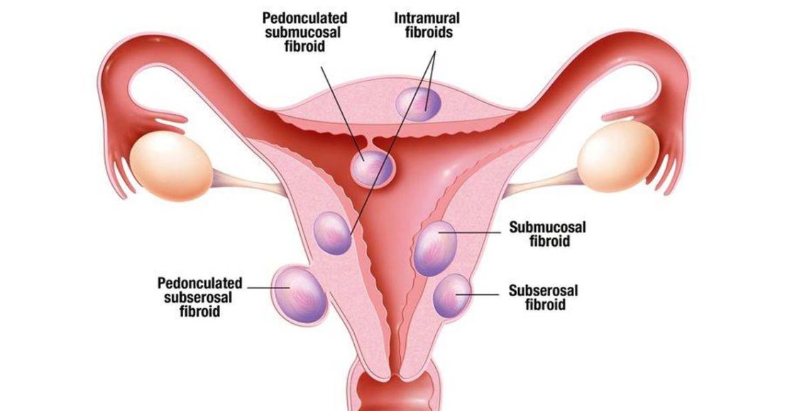What to Know About Uterine Fibroids