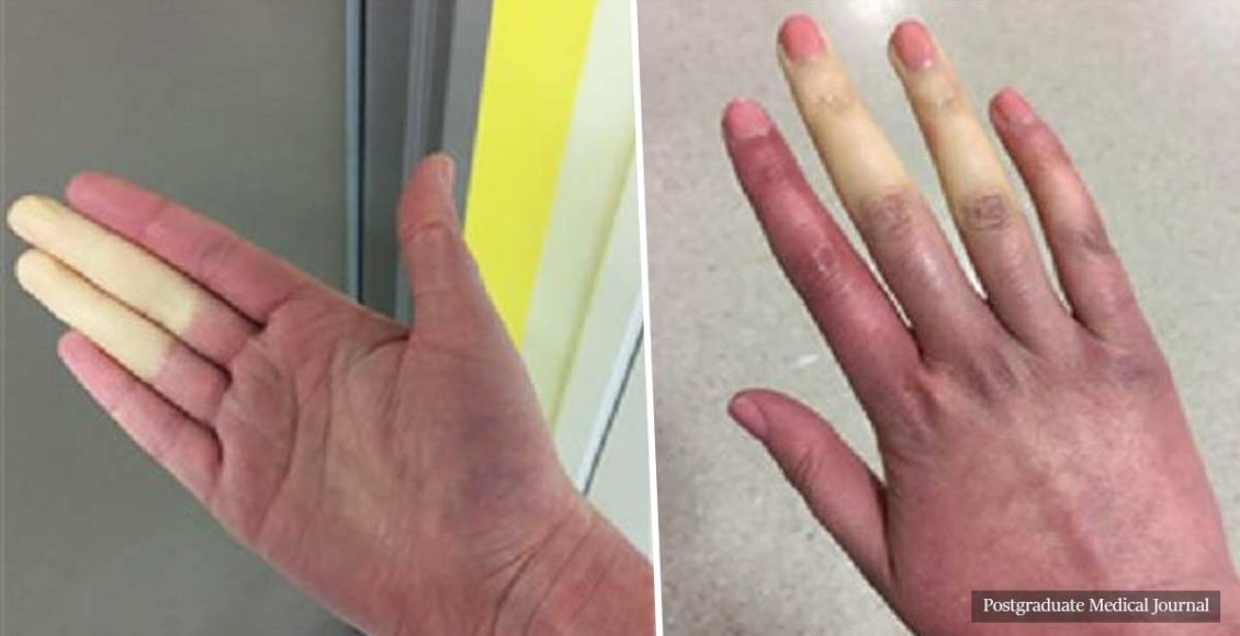 Raynaud's disease: The disorder that causes white or blue fingers