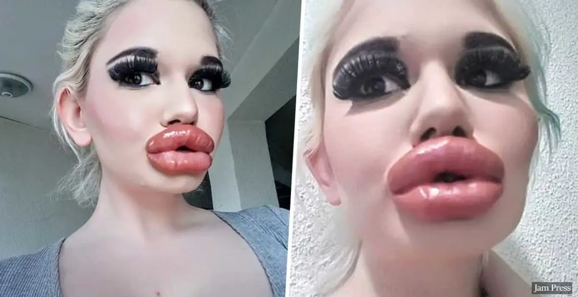 Woman, 22, spends thousands on lip injections aspiring to have the world's biggest lips