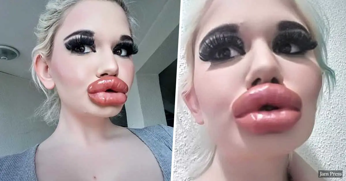 Woman, 22, spends thousands on lip injections aspiring to have the world's biggest lips