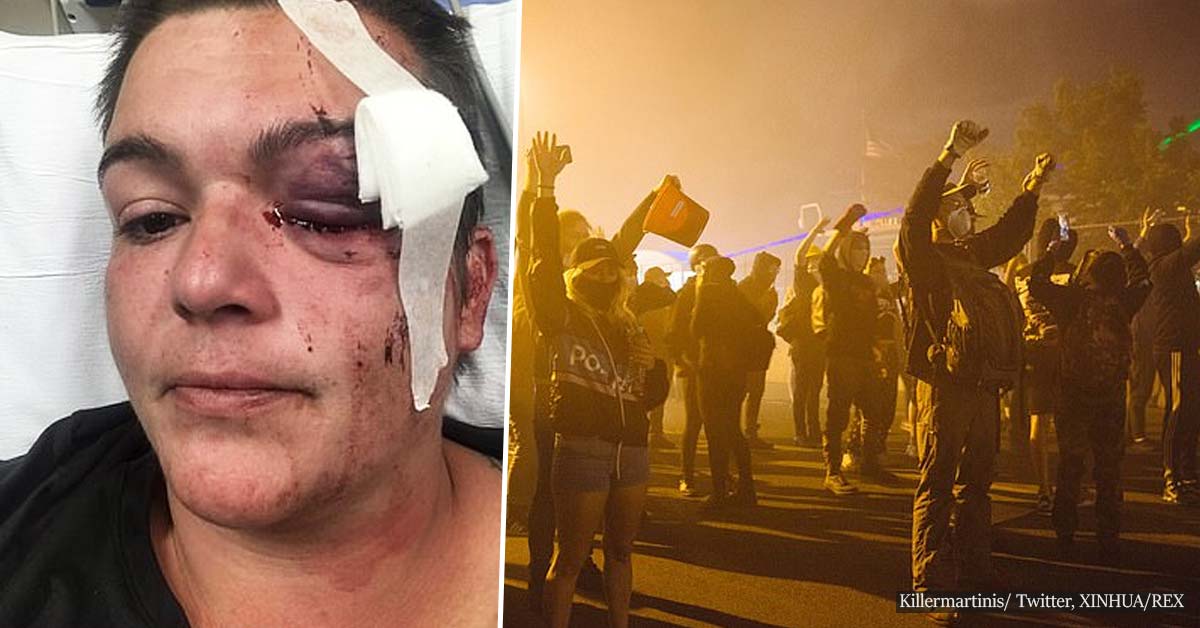 Journalist Is Left Blind In One Eye After 'being shot with a rubber bullet'