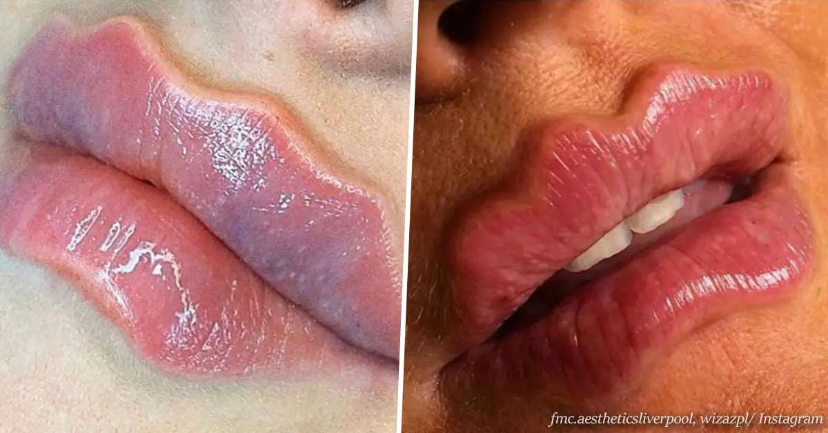 Wavy lips: The latest social media beauty trend that shocked everyone