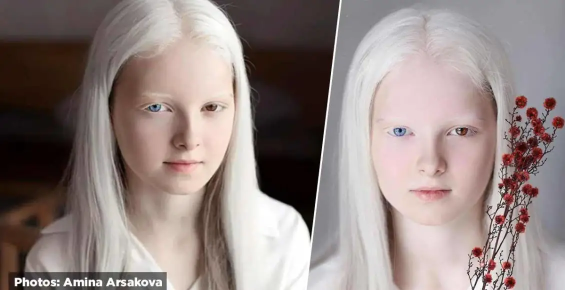 Heavenly photoshoot highlights the unique beauty of a girl with albinism and heterochromia