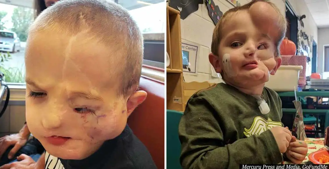 Boy, 5, whose face was ripped off in dog attack gets called 'monster' in public