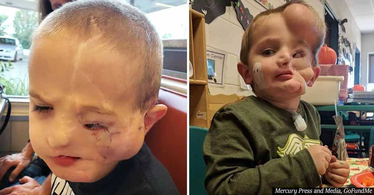 Boy, 5, whose face was ripped off in dog attack gets called 'monster' in public