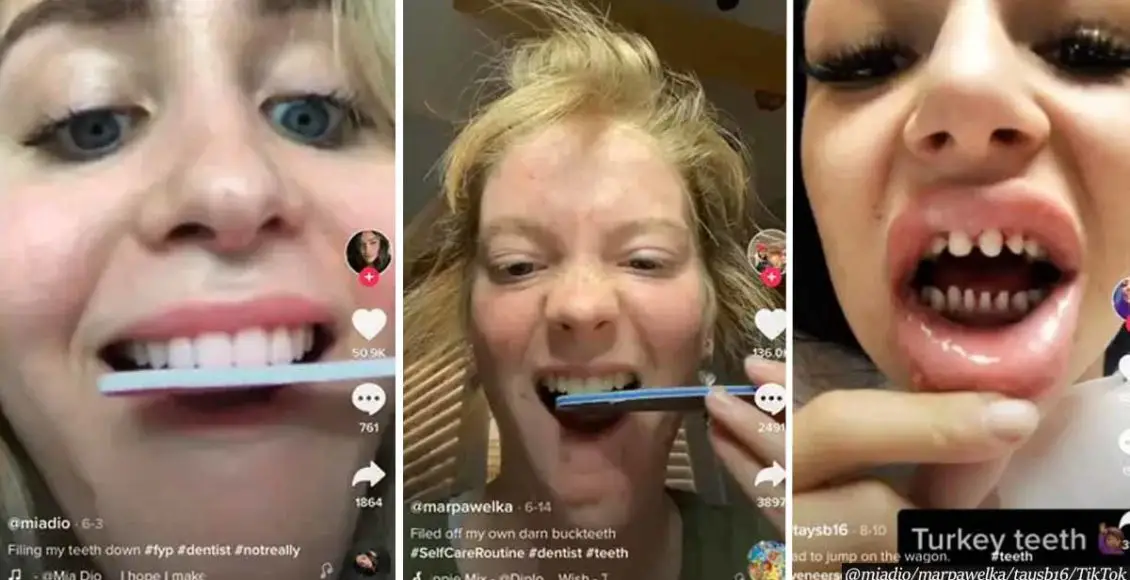 TikTokers who shave down their teeth with nail files will suffer permanent damage, dentists warn