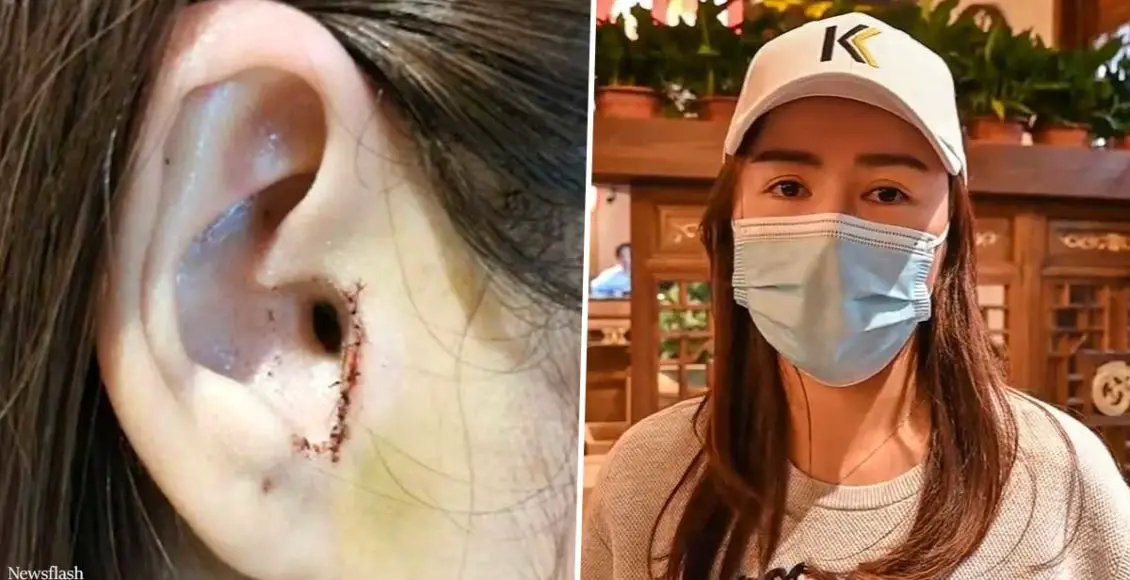 Woman outraged after doctors removed part of her ear during nose job operation