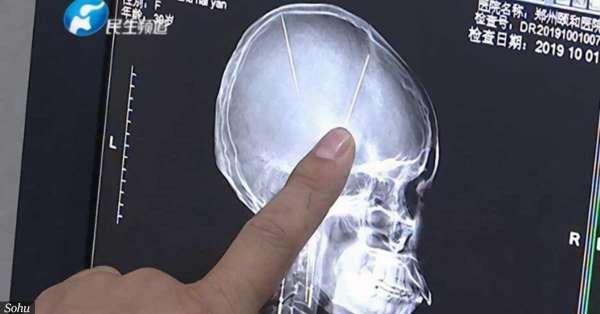 Woman shocked to discover two long needles stuck in her brain for years