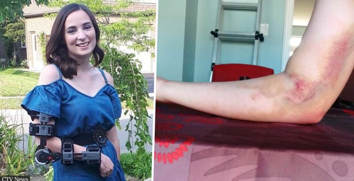А routine Blood Donation left a young woman Permanently Disabled