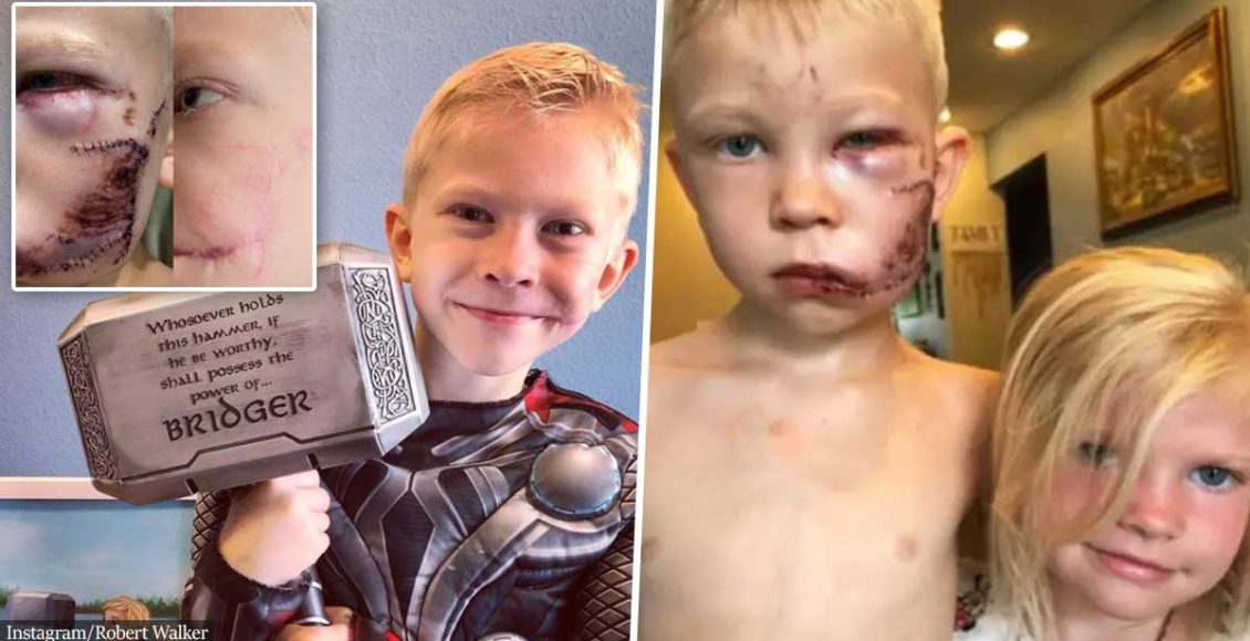 Boy, 6, mauled while saving sister from dog attack has scars completely transformed