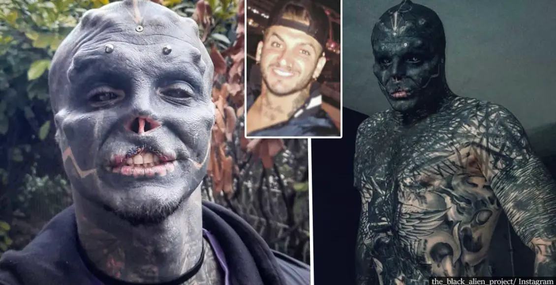 Man Had His Nose And Upper Lip Removed To Look Like A 'Black Alien'