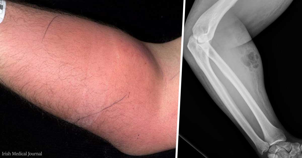 Man Hospitalized After Injecting Himself With Own Semen To "Cure" His Back Pain