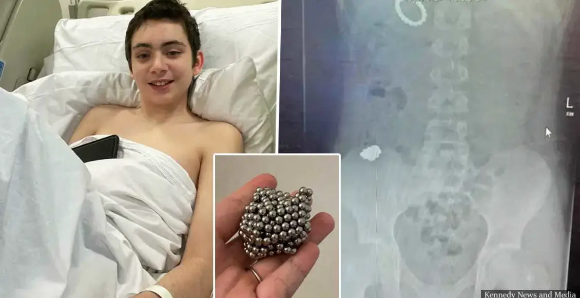 Boy Undergoes Surgery After Swallowing 54 Magnets To See If He Could Become 'Magnetic'
