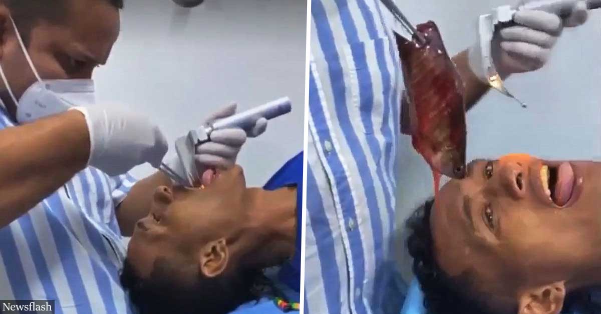 Man Gets 7-Inch-Long Fish Stuck in His Throat in Strange Fishing Accident