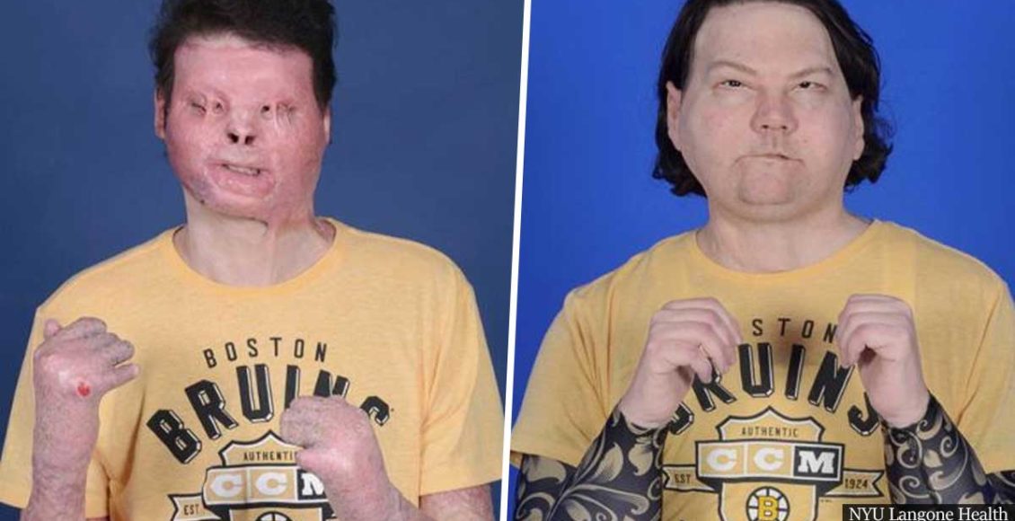 New Jersey man becomes world's first successful face and hands transplant
