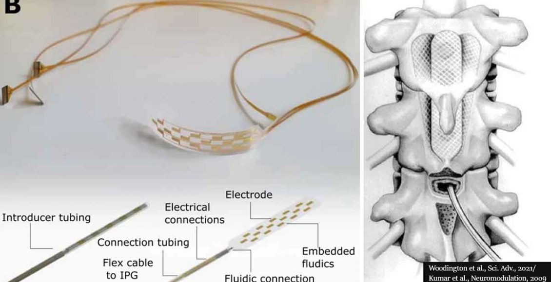 Groundbreaking 'Inflatable' spinal cord stimulator could make pain relief widely available