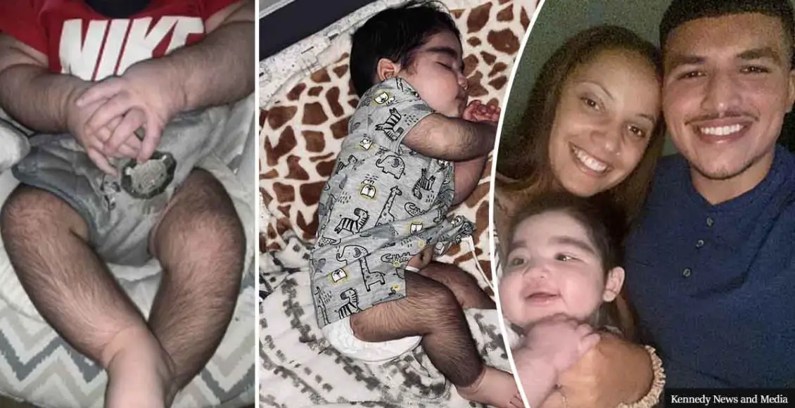 "Parents of baby with hair all over his body slam trolls who call him 'baby gorilla' and say 'WAX him' "