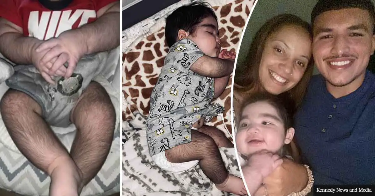 "Parents of baby with hair all over his body slam trolls who call him 'baby gorilla' and say 'WAX him' "