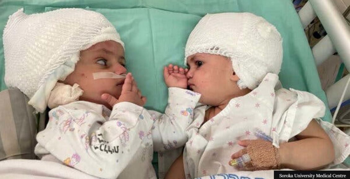 Conjoined Twin Sisters See Each Other For The First Time After Doctors Separate Their Heads Through Miracle Surgery