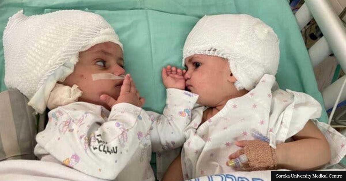 Conjoined Twin Sisters See Each Other For The First Time After Doctors Separate Their Heads Through Miracle Surgery