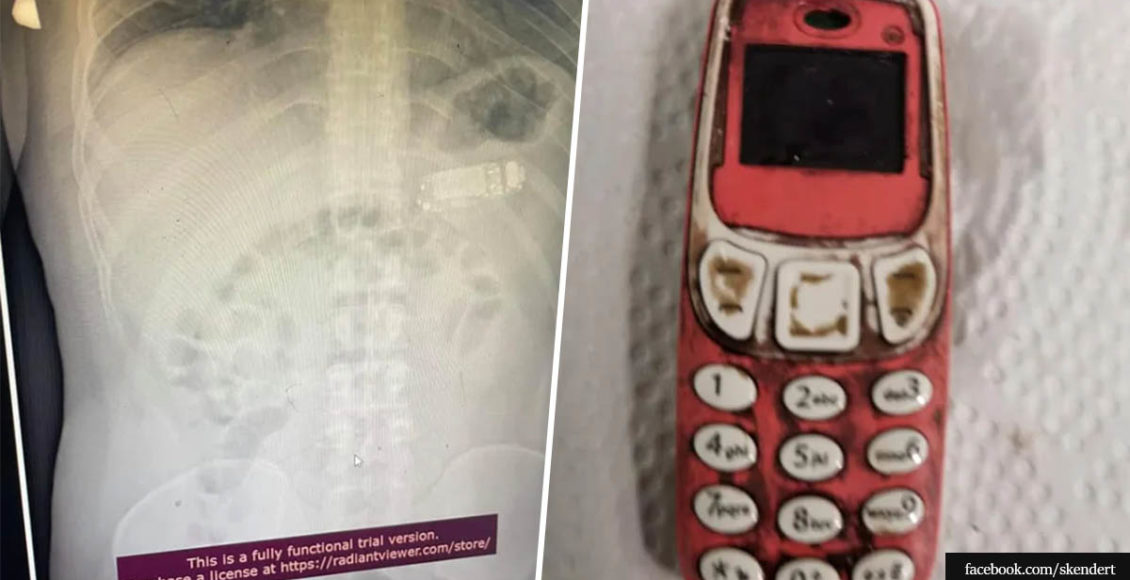 Doctors remove entire Nokia brick phone from man's stomach