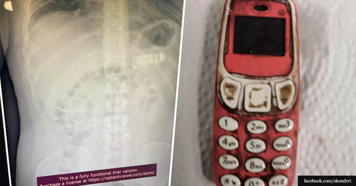 Doctors remove entire Nokia brick phone from man's stomach