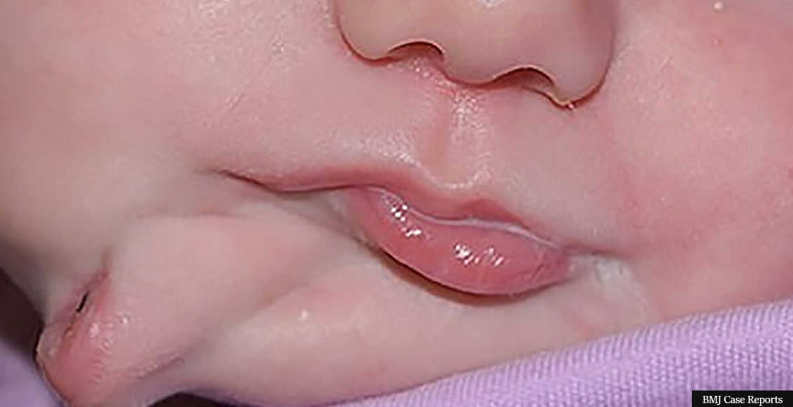 Baby girl born with second mouth has it successfully removed