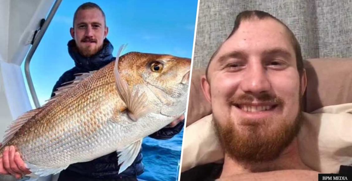 UK Man Waiting For Replacement Skull After Suffering Horrific Injuries In Vicious Assault In New Zealand