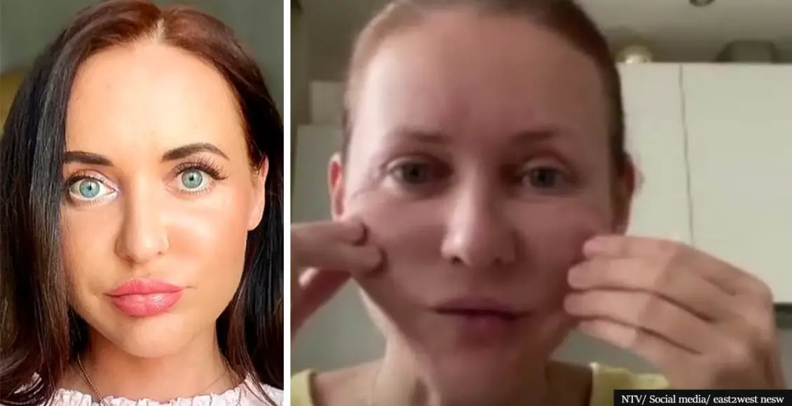 Woman's face 'shrank like a mummy' after beauty treatment aged her 10 years overnight