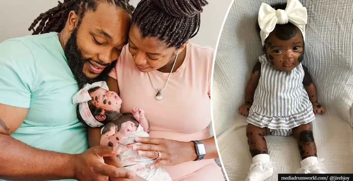 Beautiful baby girl born with unique condition that causes dark spots all over her body