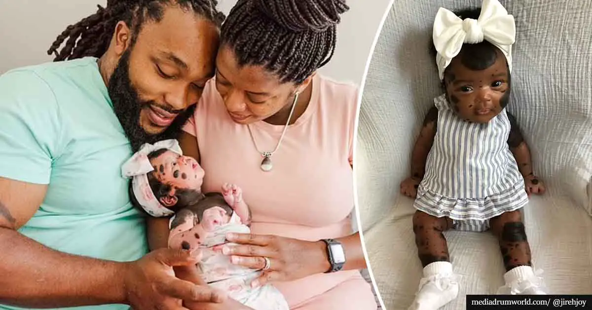 Beautiful baby girl born with unique condition that causes dark spots all over her body