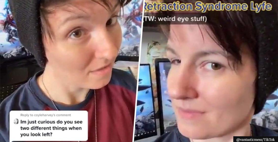 Creepy eye condition where eyeballs can’t move to one side shocks TikTokers