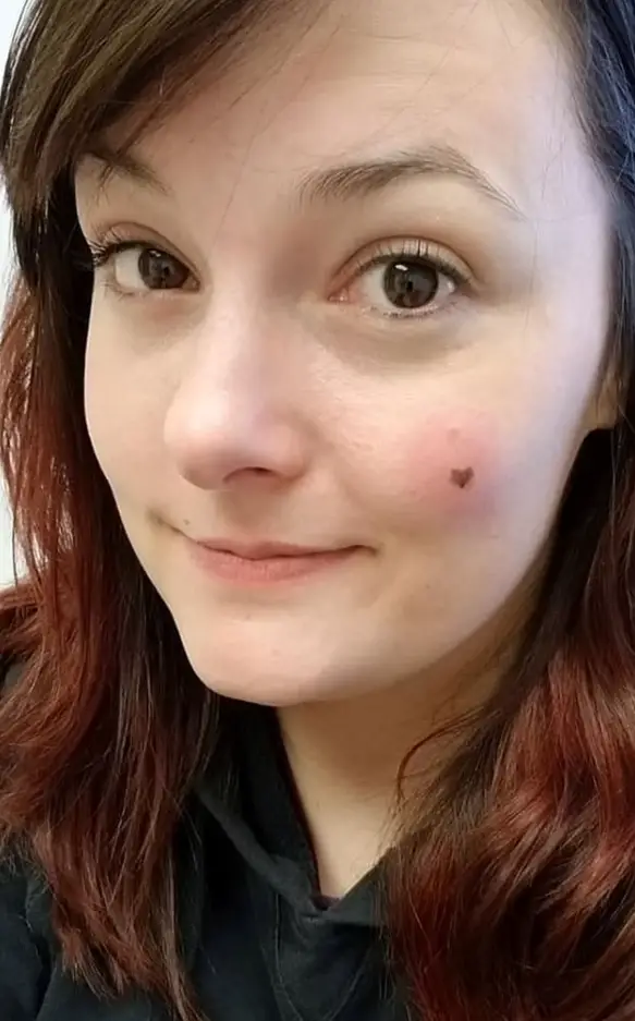 Woman Devastated As Super Cute Heart Shaped Freckle Turns Out To Be Highly Agressive Cancer
