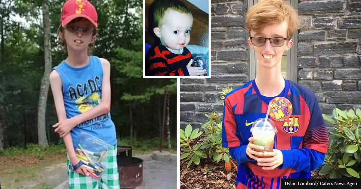 Teenager has ultra rare condition that means he can never gain weight