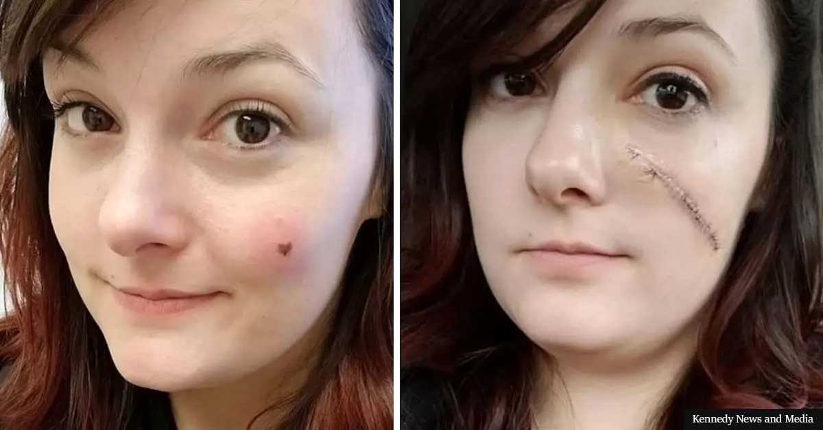 Woman devastated as 'super cute' heart-shaped freckle turns out to be 'highly agressive' cancer